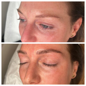 A woman with her eyes closed and before and after photos of the same procedure.