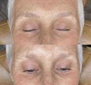 A before and after picture of an older woman 's eyes.